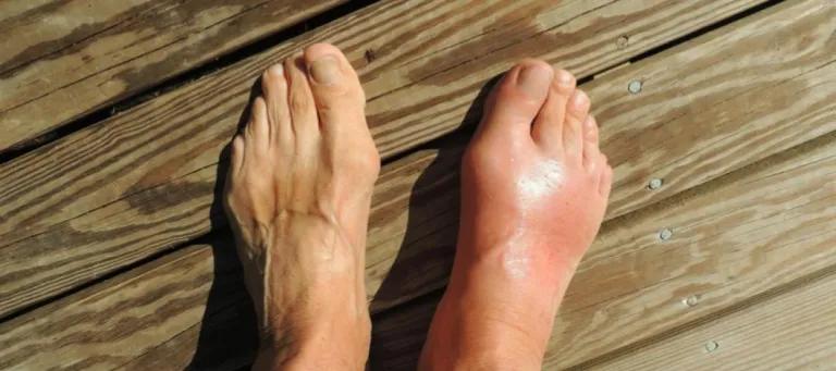 An image of swollen feet